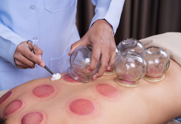What are the Benefits of Acupuncture for Psoriasis?